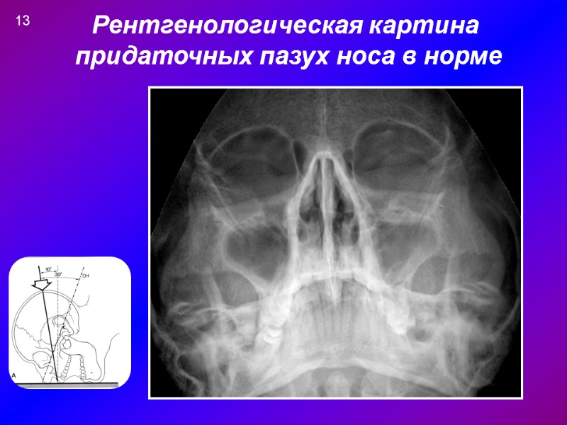 Рентгенологическая картина  придаточных пазух носа в норме 13
